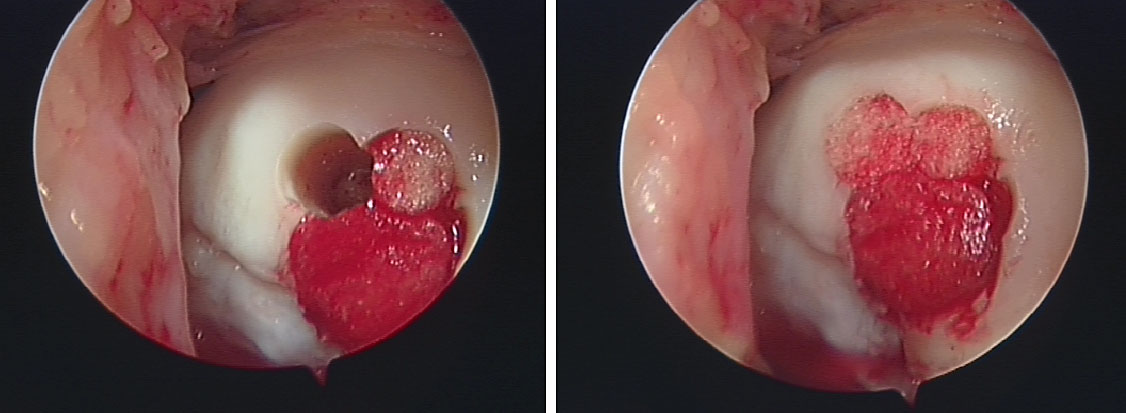 image showing Defect in medial femoral condyle treated with OATS (Mosiacplasty) treated by Mr. Aslam Mohammed.